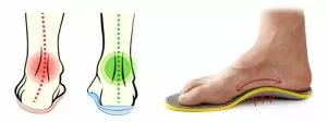 Ортопедични стелки за плоскостъпие