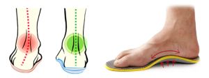 Ортопедични стелки за плоскостъпие
